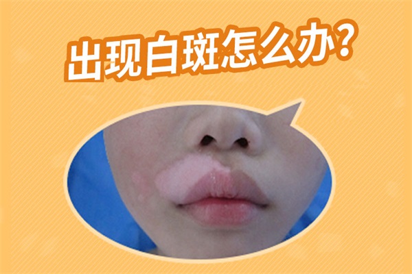 臉上有白斑要怎么辦、面部白癜風(fēng)如何治療